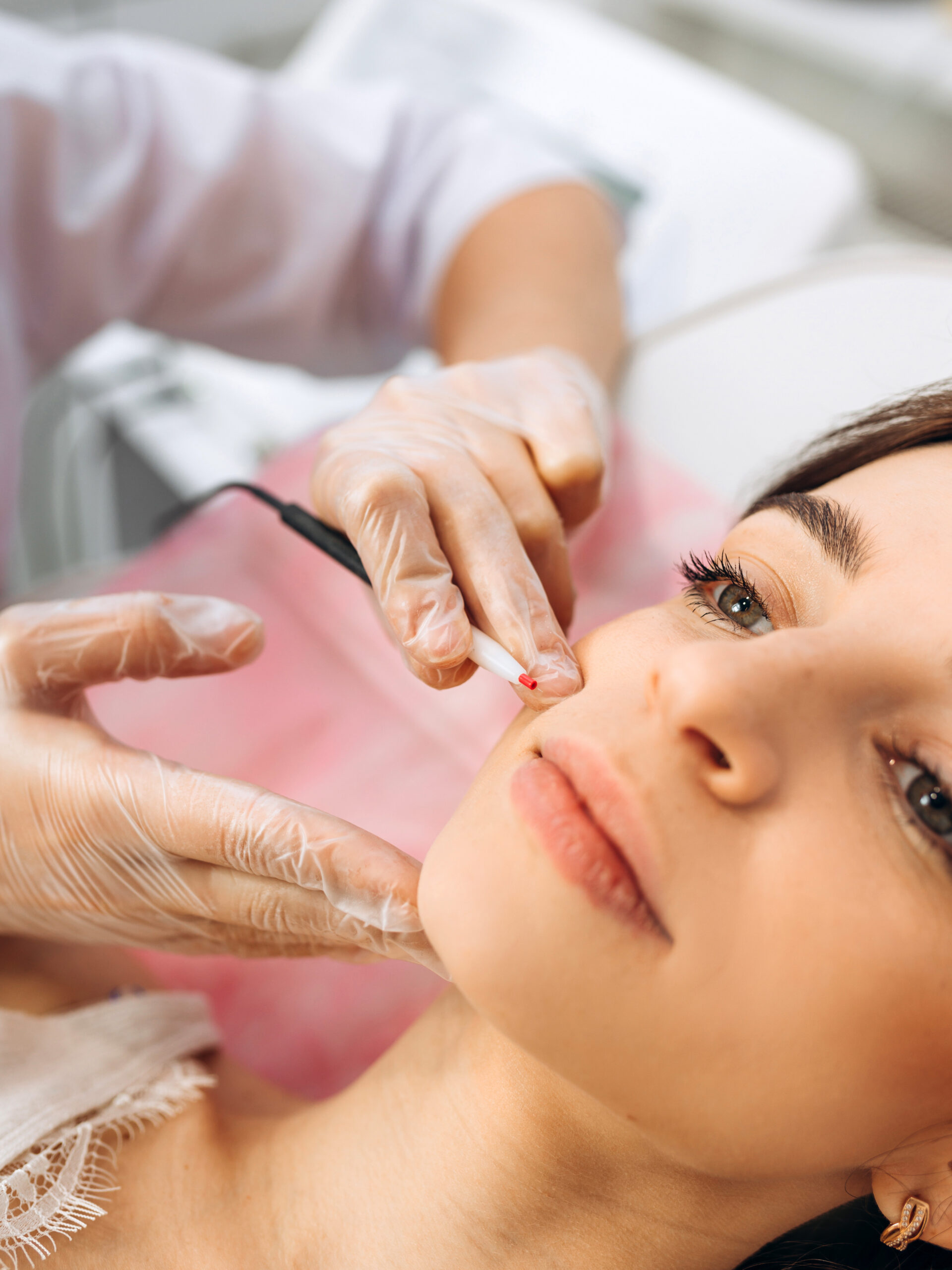 Closeup image of dermatologist's hands doing electro-epilation. The process of electrolysis on the face. Beauty concept, the needle of electrolysis. Doctor working in cosmetic medical cabinet. Cosmetic specialist performing skin tightening on woman's face at Elite 360 clinic, precision aesthetic treatment, soft pink tones.